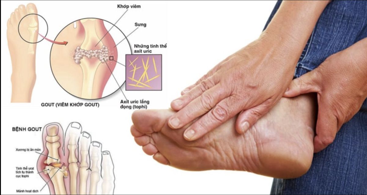 Gout, Tiểu Đường, Mỡ Máu – Đừng Chỉ Trông Chờ Vào Thuốc!